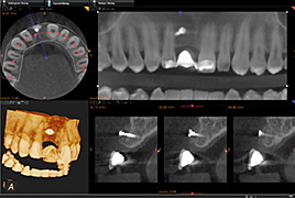 Dental Volumetrik Tomografi(DVT)